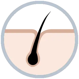 Direct Hair Implantation