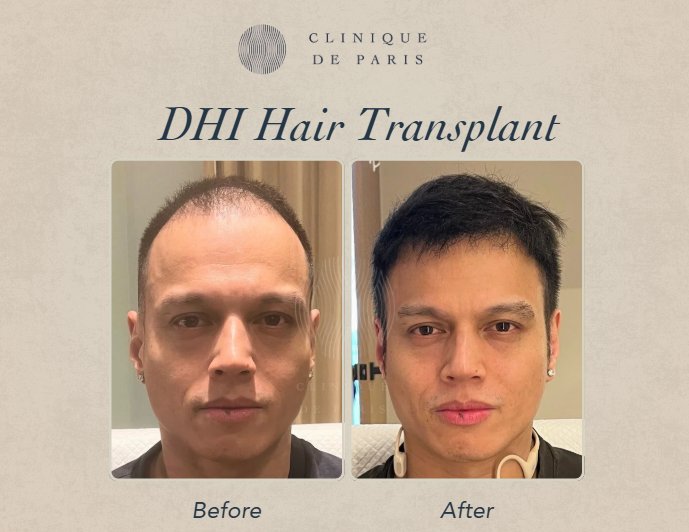 Clinique de Paris Hair Transplant Results