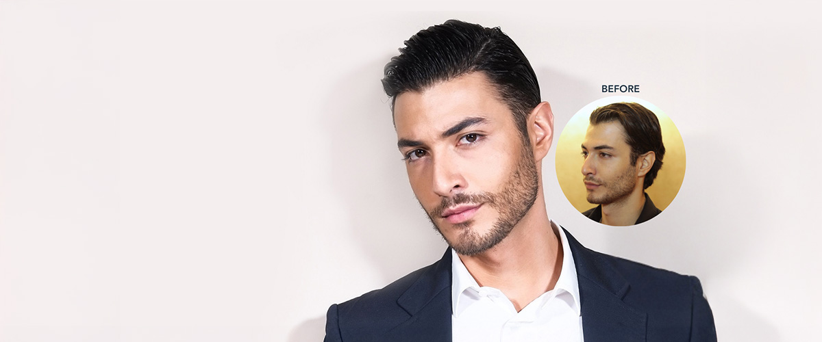 Clinique de Paris is the best hair transplant clinic in the Philippines