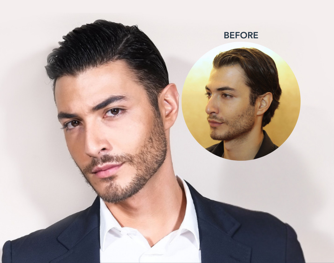 Clinique De Paris - Direct hair Implantation