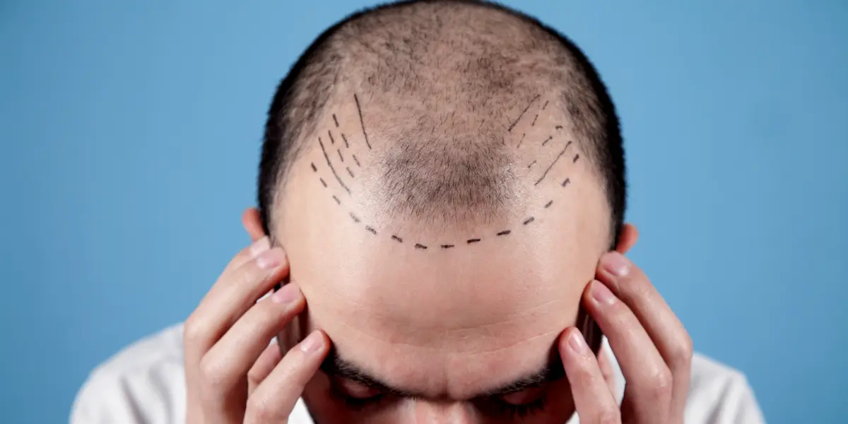 Clinique De Paris - Are Hair Transplants Permanent