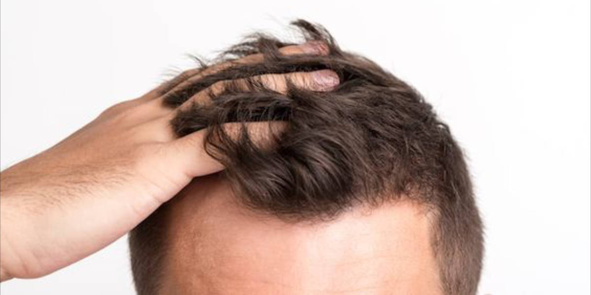 A Guide on Choosing the Right Hair Transplant Clinic