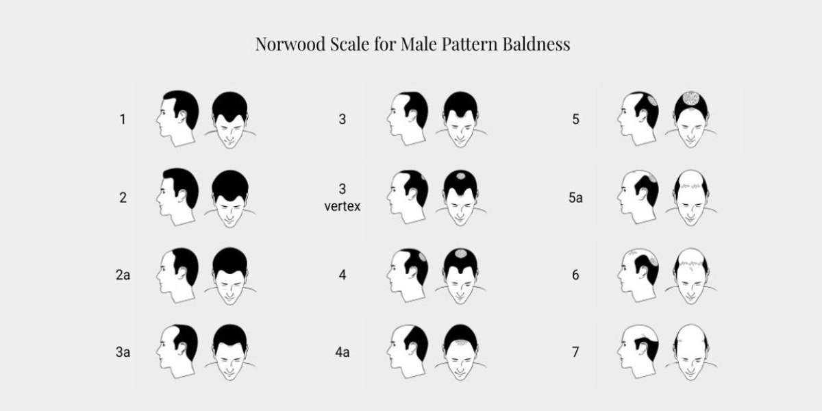 Norwood scale for male pattern baldness