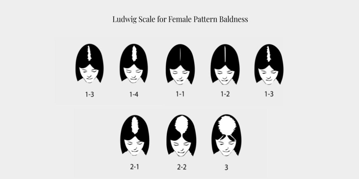 Ludwig scale for female pattern baldness