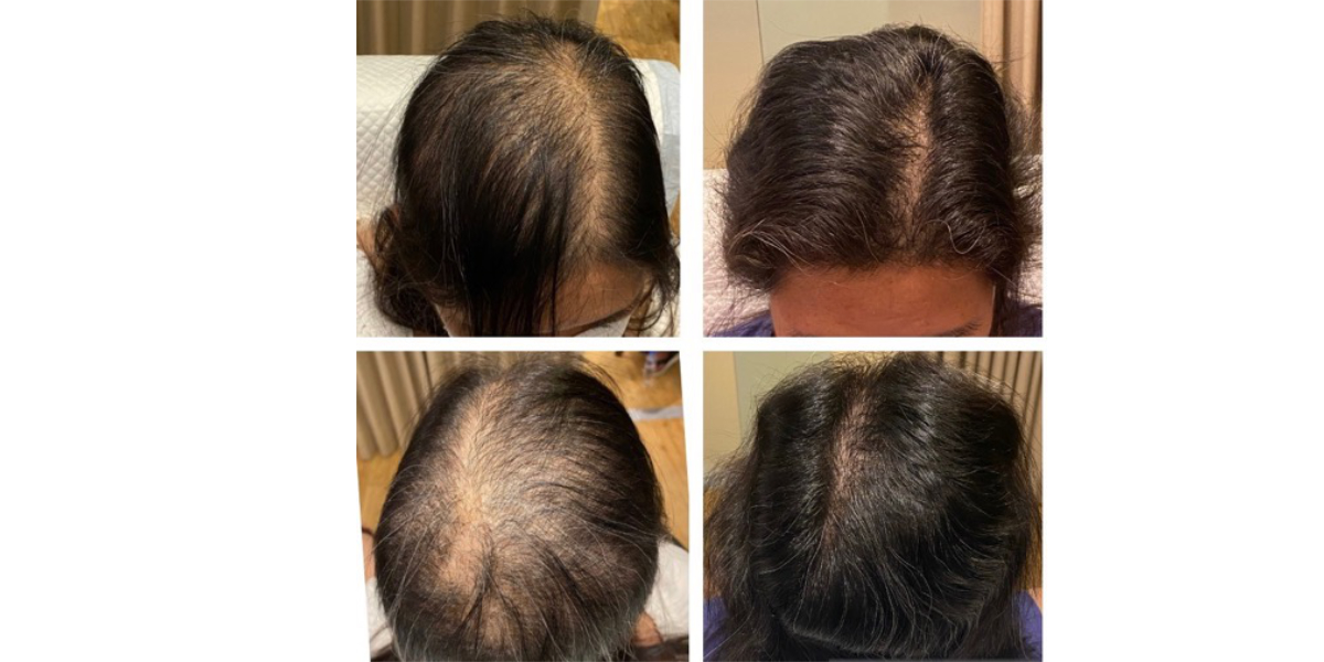 Minoxidil and Finasteride before and afters