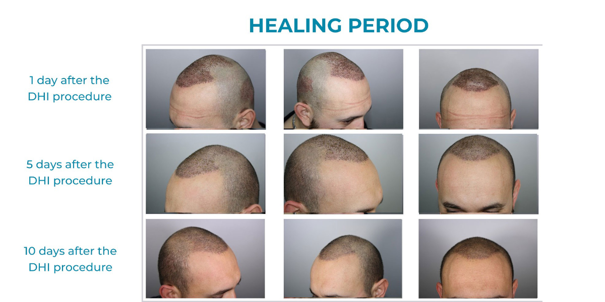 Direct Hair Implantation healing period guide