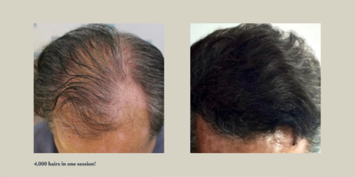 An image of a hair transplant before and after showing fuller head