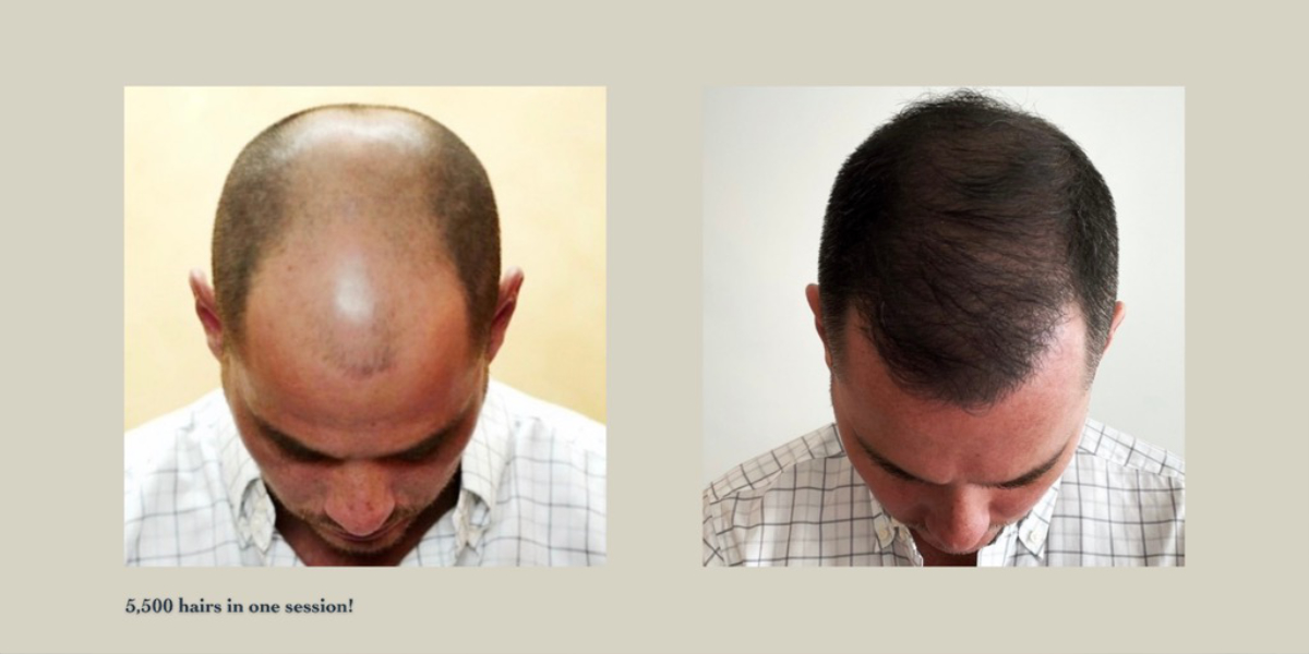 An image of a hair transplant before and after showing hair density