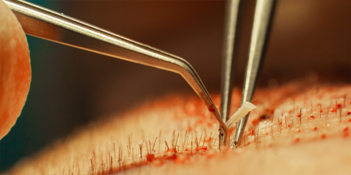 An image of a hair graft being extracted