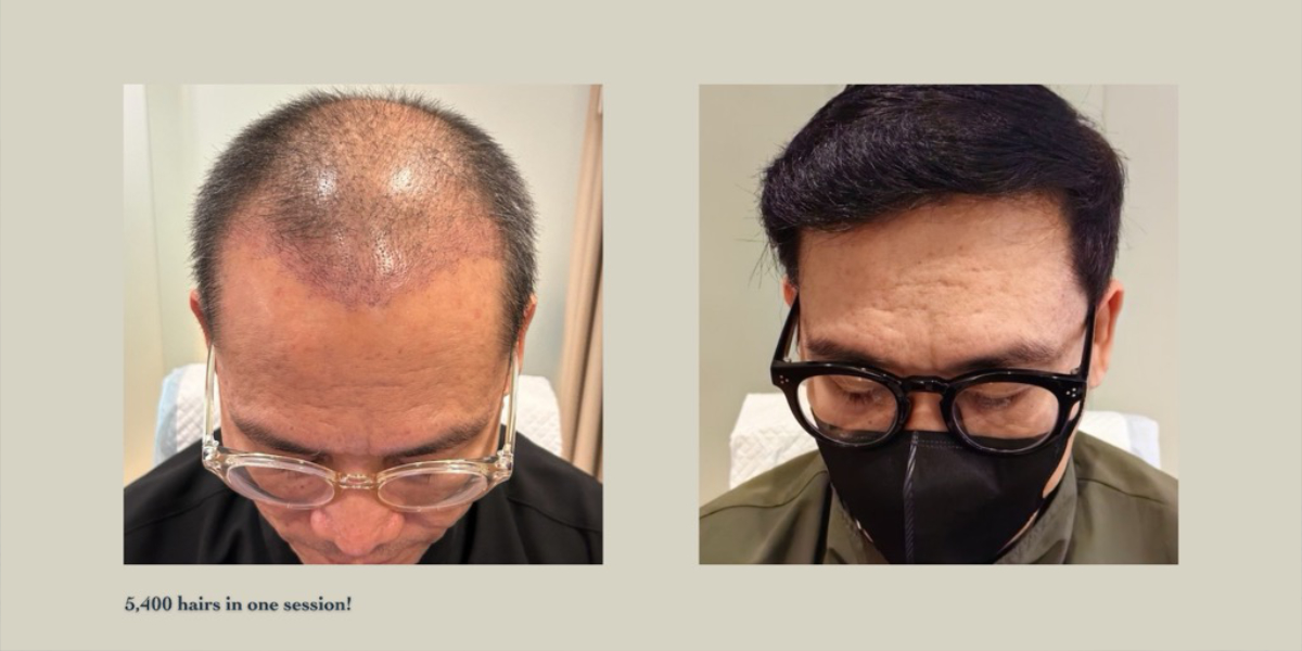 An image of a hair transplant before and after showing new hairline