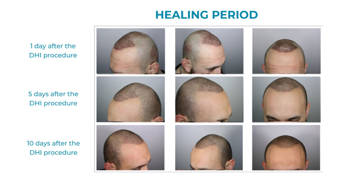 DHI Hair Transplant recovery timeline
