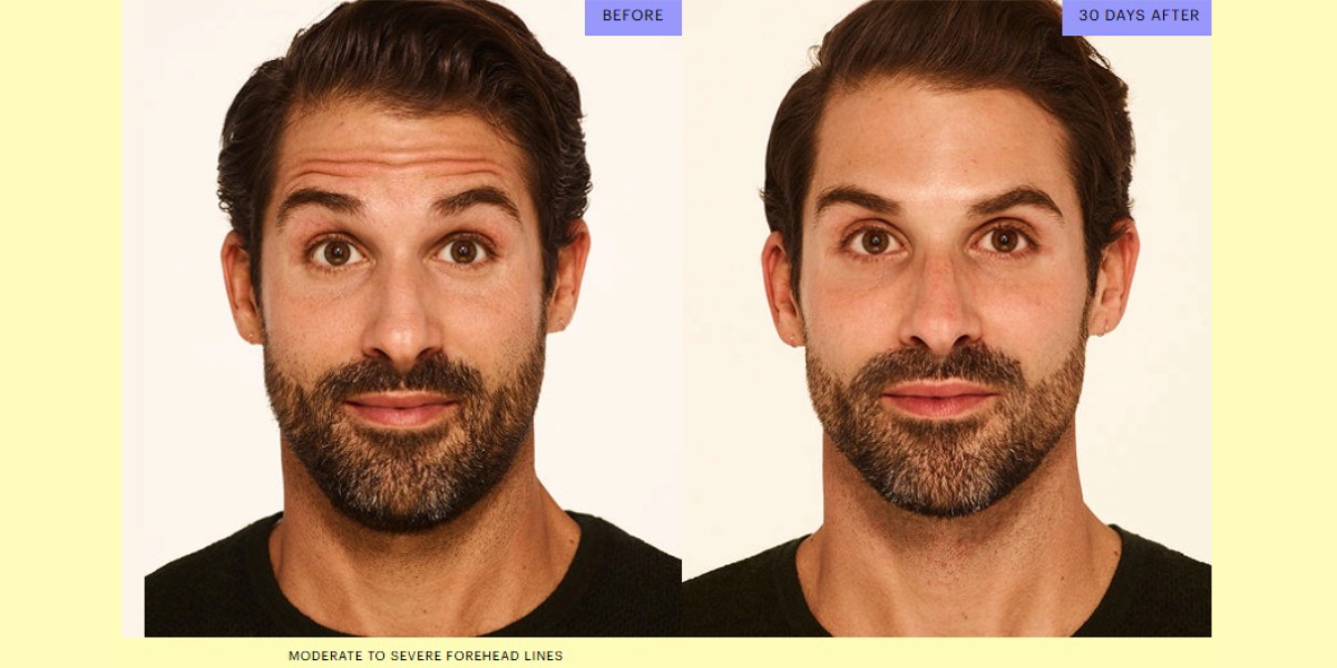 Botox results for men