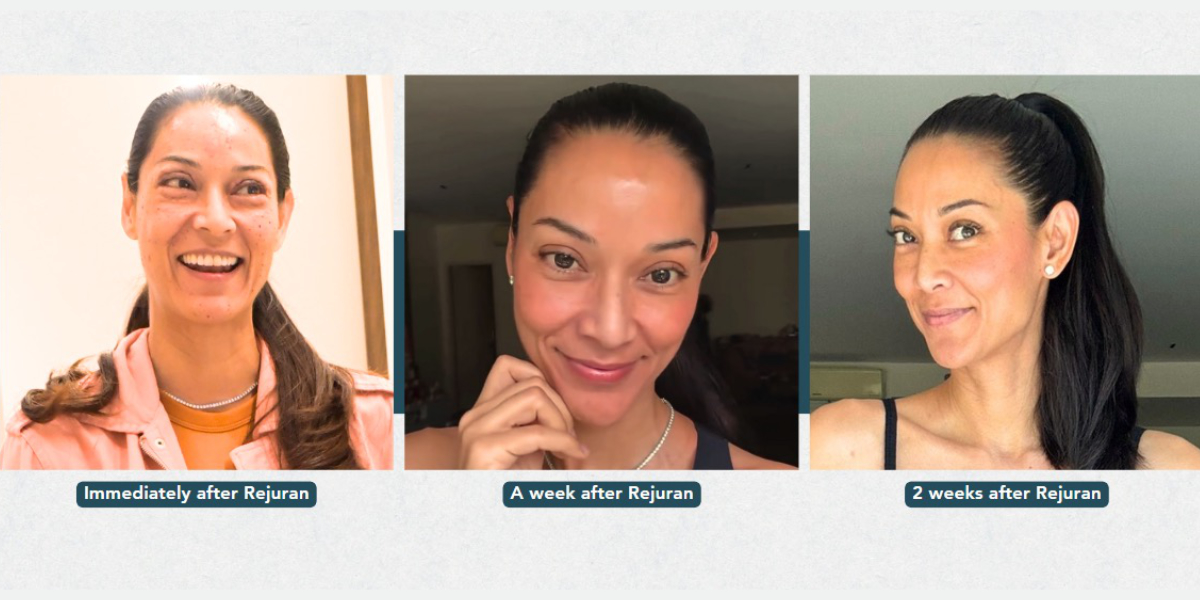 Clinique de Paris Rejuran Before and After