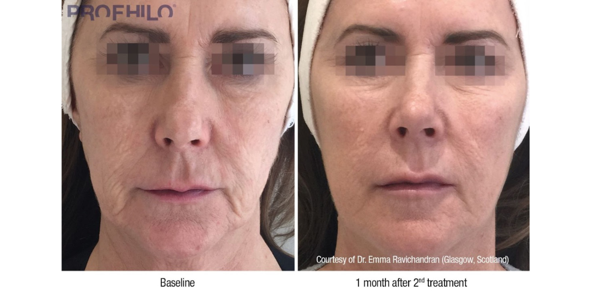 Profhilo Before and After