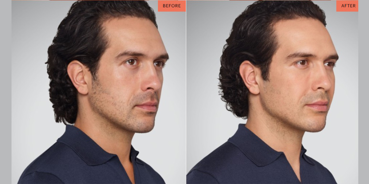 Juvederm fillers before and after