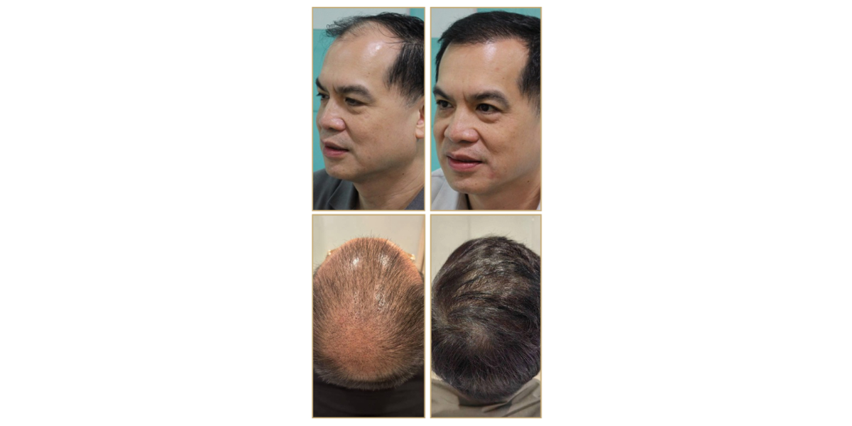 Before and after photos after a hair transplant