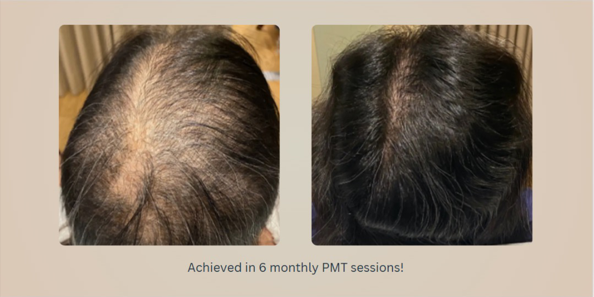 An image of a before and after of a woman who did PRP treatment or Platelet Mesotherapy after six sessions