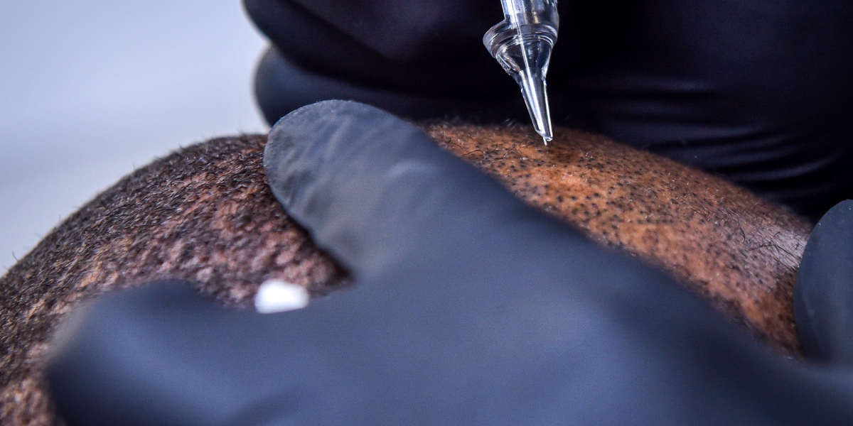 An image of a head undergoing scalp micropigmentation