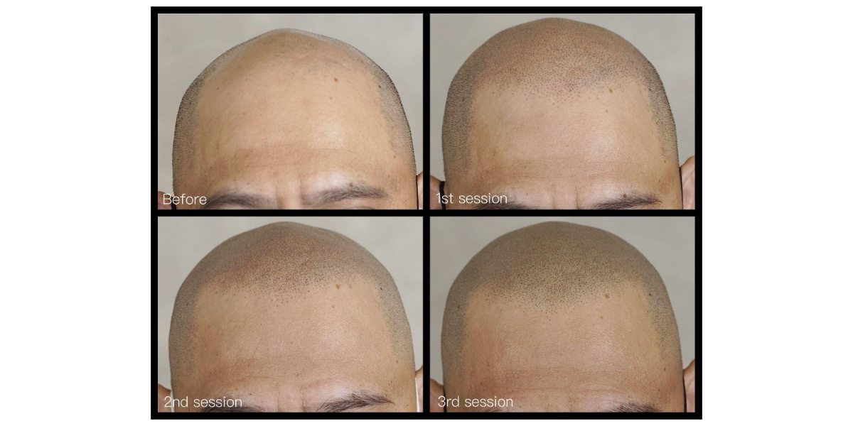 A before and after image of a man who did scalp micropigmentation