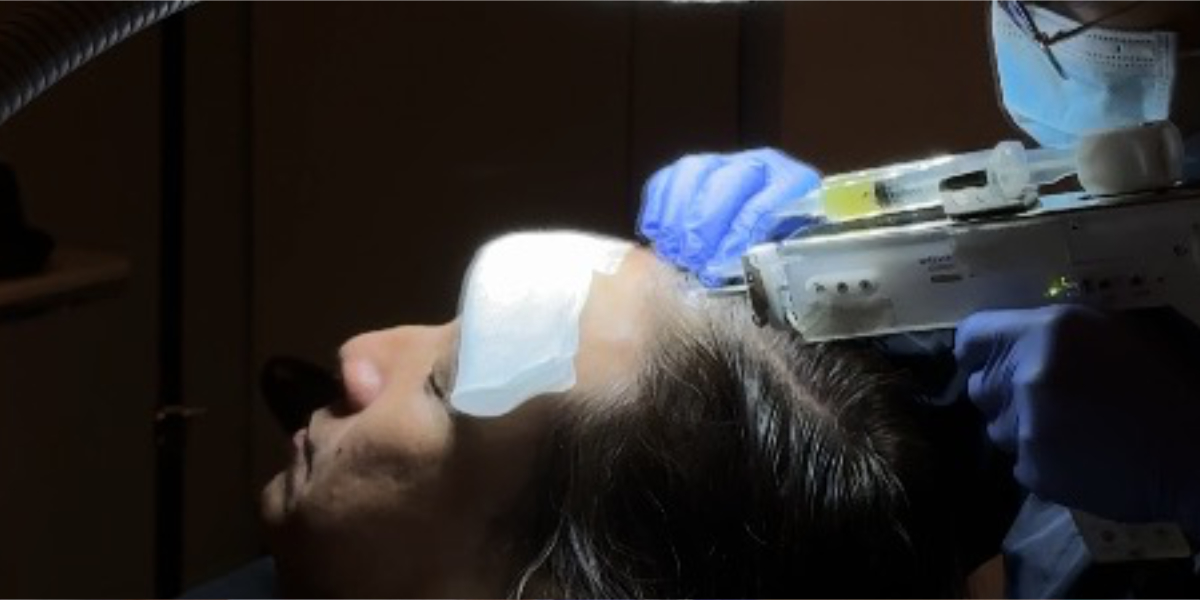 An image of woman getting a PRP treatment or Platelet Mesotherapy