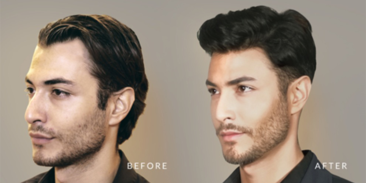 Hair Transplant Results Men