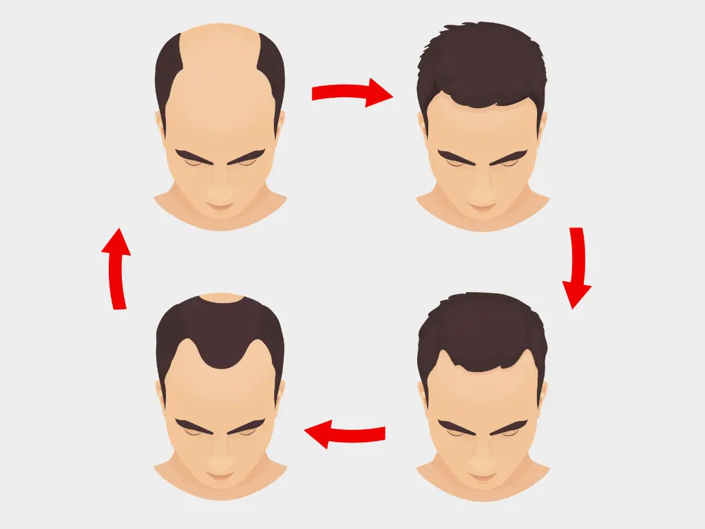 Hair transplants can treat hair loss or alopecia in men and women