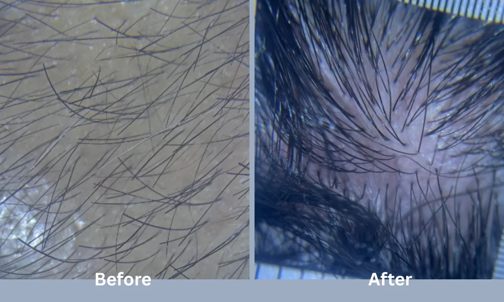 before and after treatment of trichoscopy image showing increased hair density and improved scalp condition