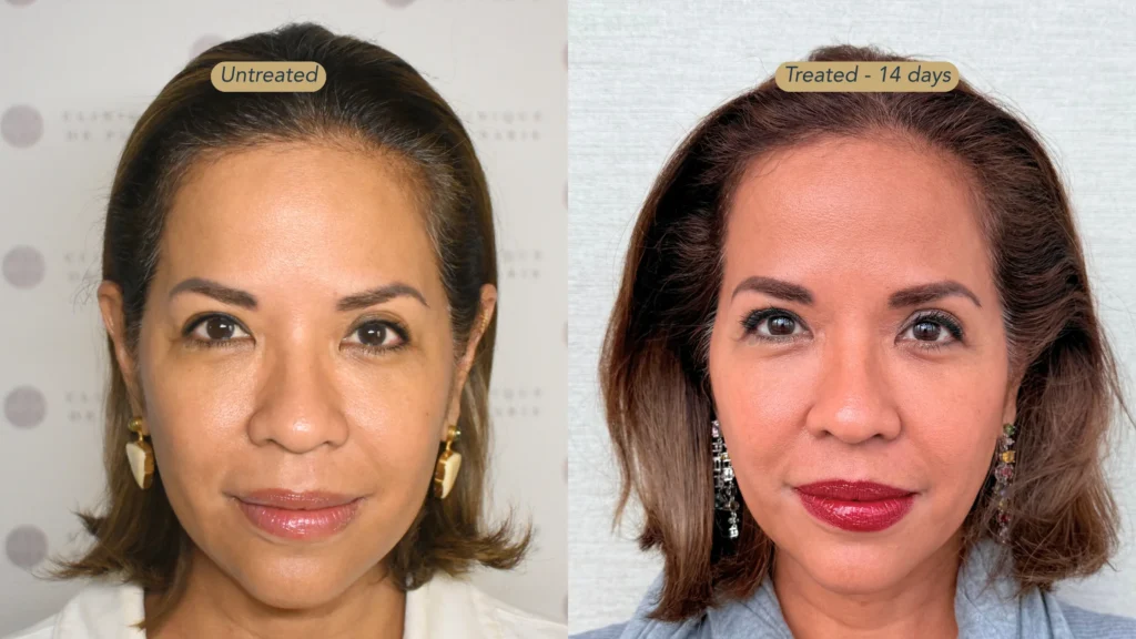 Before and after results showing improved skin texture after Rejuran treatment