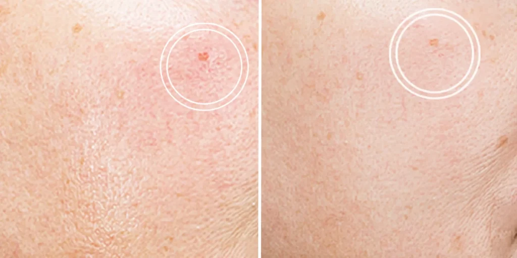 Close-up of smooth, healthy skin showing improvement in acne scars after Rejuran treatment at Clinique de Paris