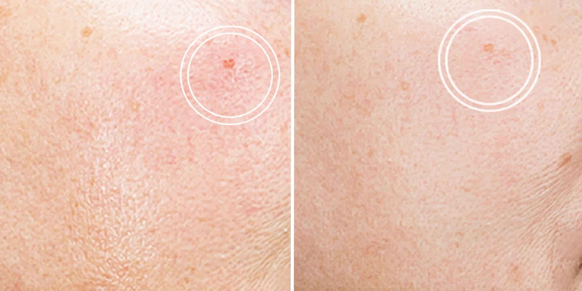 Close-up of smooth, healthy skin showing improvement in acne scars after Rejuran treatment at Clinique de Paris