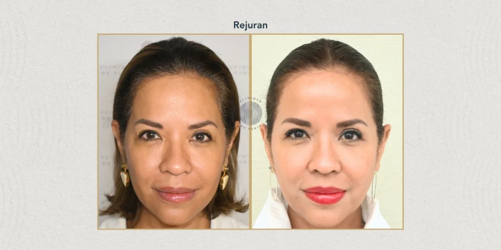 Full Rejuran results after multiple treatment sessions showing improvement in acne scars (atrophic, boxcar, rolling), rough uneven skin texture, post-inflammatory healing, hyperpigmentation (PIH), and skin barrier repair.