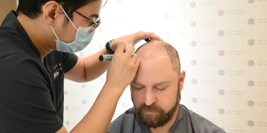 An international patient consults with a Clinique de Paris doctor as they carefully design and map his new hairline before a DHI hair transplant procedure.