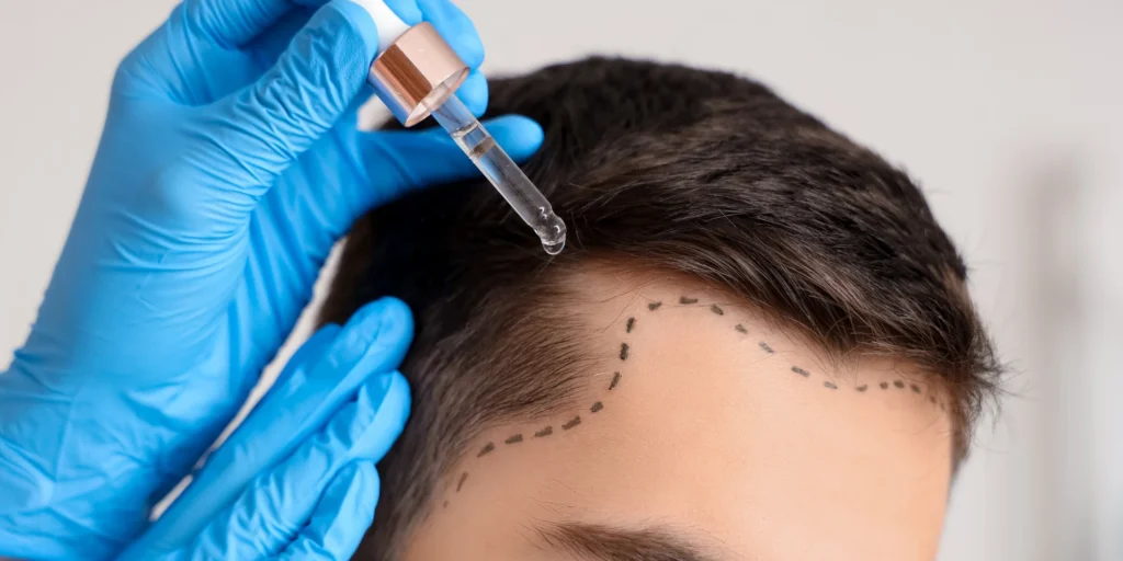 Man applying topical hair serum to scalp for hair loss treatment