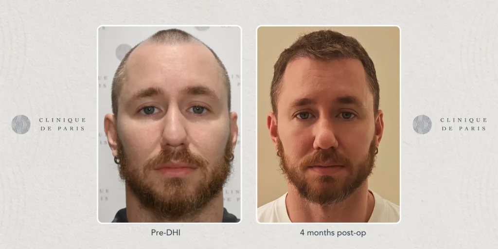 Why Are International Patients Choosing the Philippines for Hair Restoration?