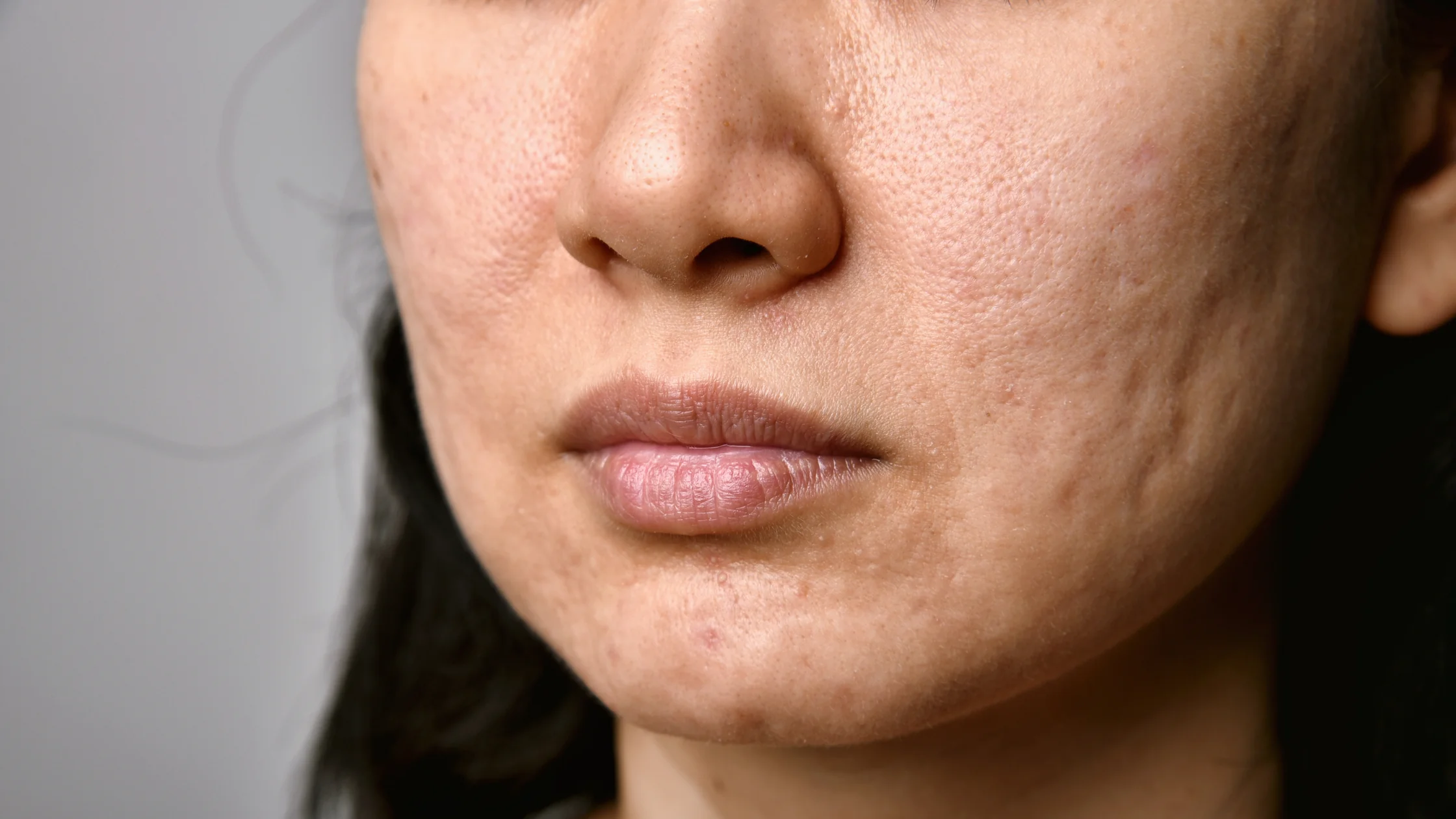 The Best Treatment for Acne Scars That Actually Works!