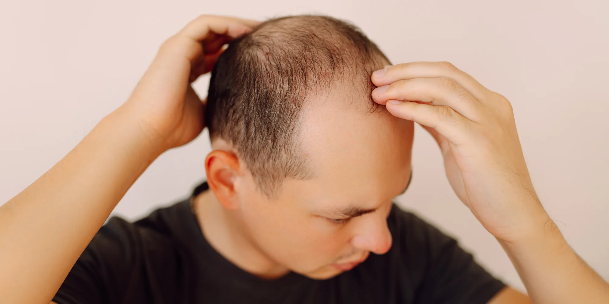 Postpartum Hair Loss in Men: Can Fathers Experience It?