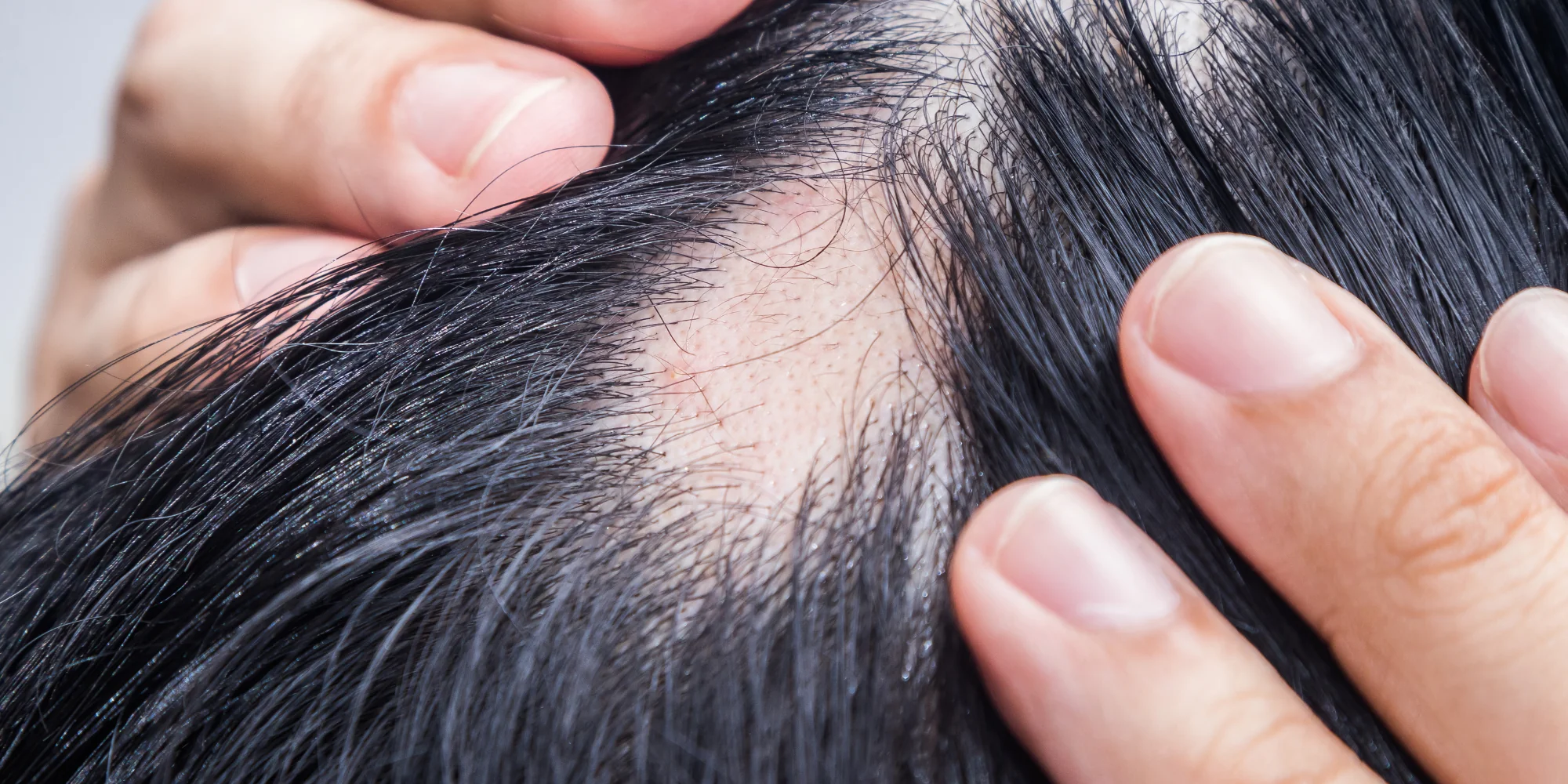 5 Common Types of Alopecia | Clinique de Paris