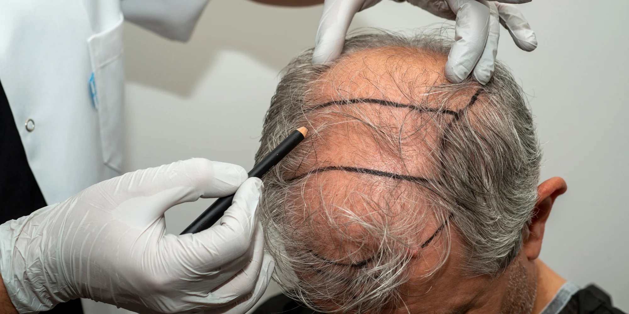 Robotic Hair Transplant: Pros, Cons & How It Works!